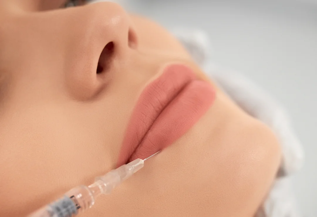 "Injection d'acide hyaluronique – Repulper naturellement les lèvres