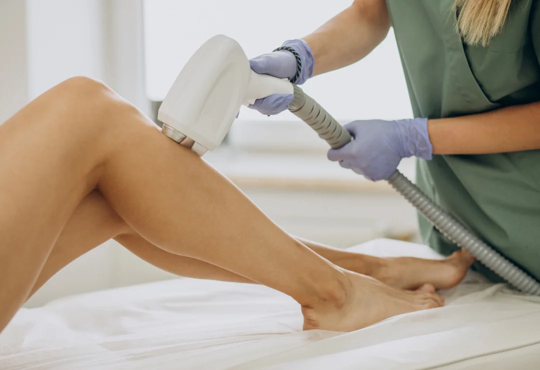 Épilation laser – Solution durable pour une peau lisse